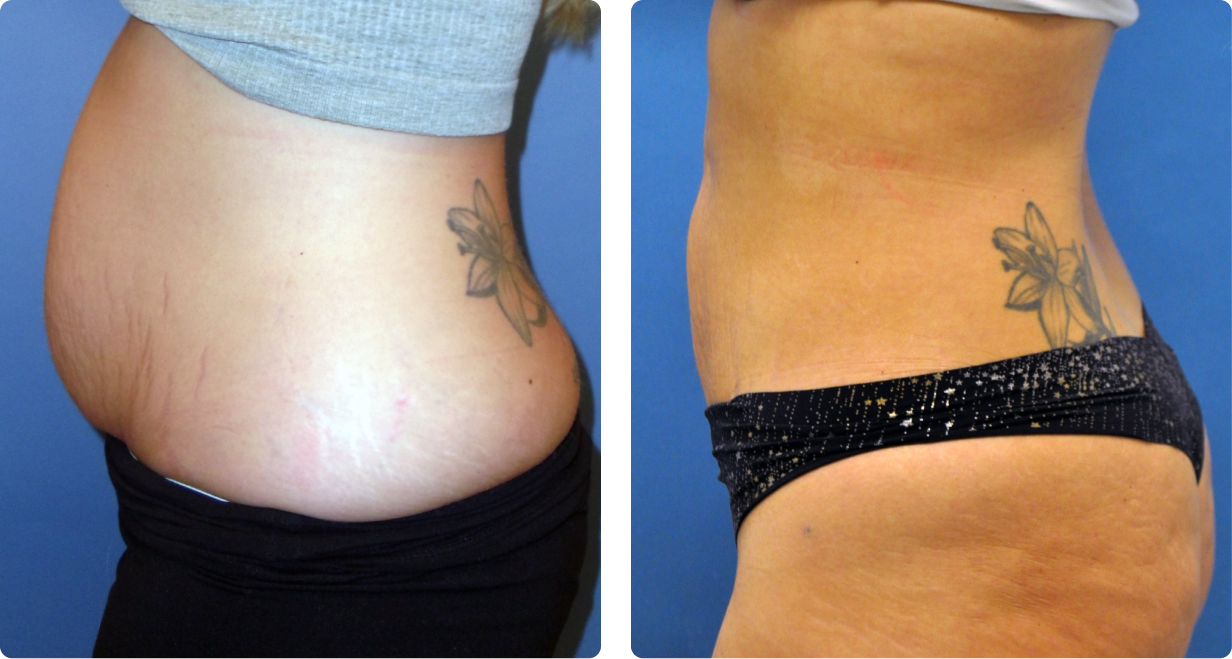 Female tummy, before and after BeautiFill treatment, l-side view - patient 1