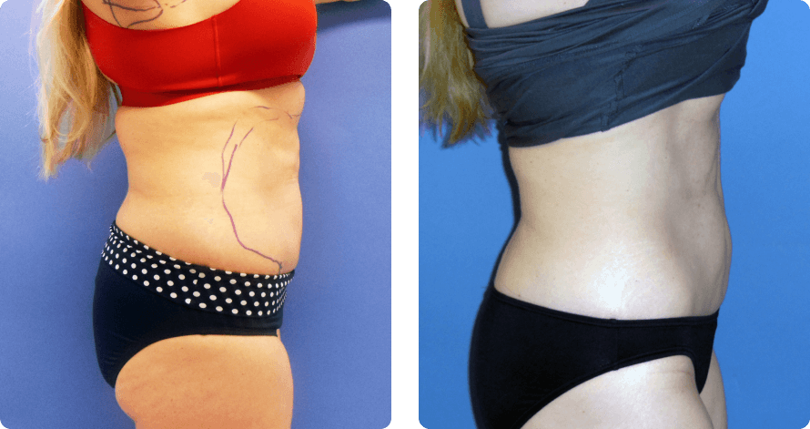 Woman’s body, before and after Morpheus8 Body treatment, r-side view, patient 1