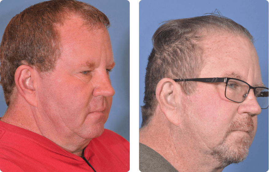 Male face, before and after Neograft Hair Restoration treatment, r-side oblique view, patient 1