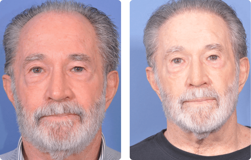 Male face, before and after Neograft Hair Restoration treatment, front view, patient 2