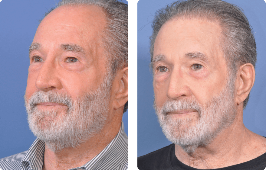 Male face, before and after Neograft Hair Restoration treatment, l-side oblique view, patient 2