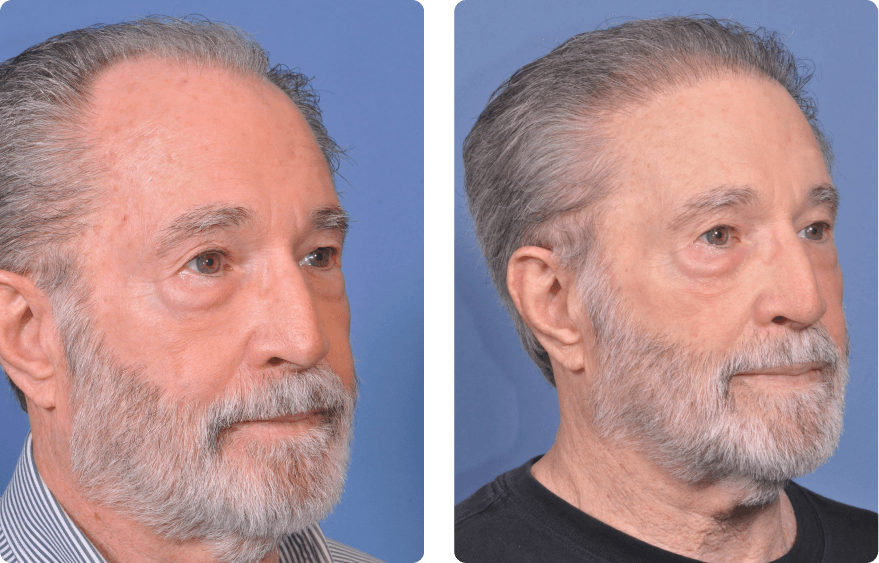 Male face, before and after Neograft Hair Restoration treatment, r-side oblique view, patient 2
