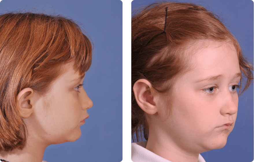 Young girl face, before and after Ear Pin Back (Otoplasty), r-side view, patient 1