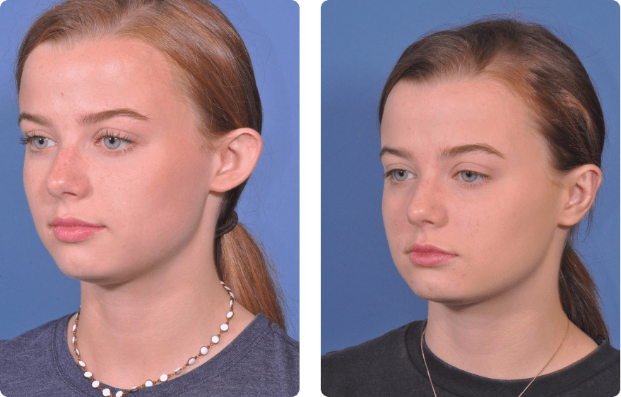 Young girl face, before and after Ear Pin Back (Otoplasty), l-side oblique view, patient 2