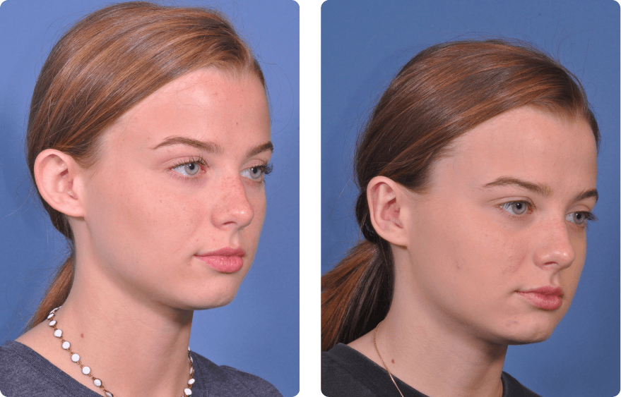 Young girl face, before and after Ear Pin Back (Otoplasty), r-side oblique view, patient 2