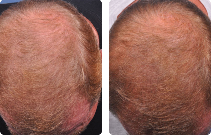 Before and After Photos: Platelet-Rich Plasma