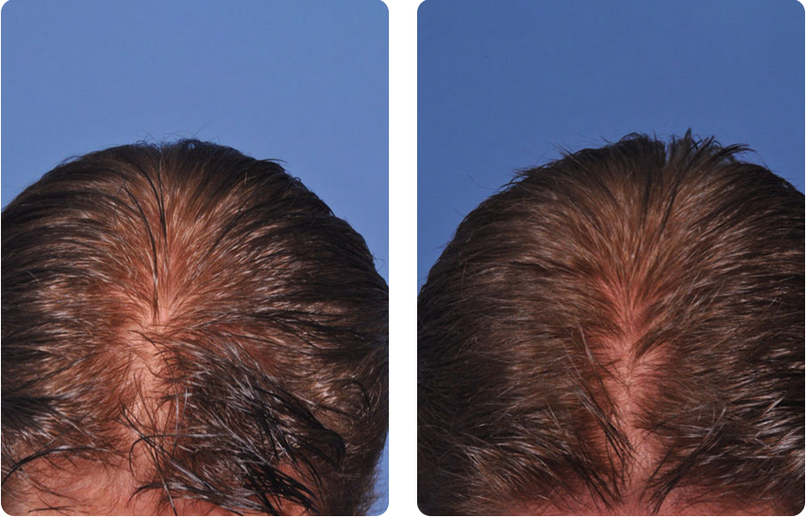 Patient 3, head hair before and after Platelet-Rich Plasma (PRP) treatment, front view.