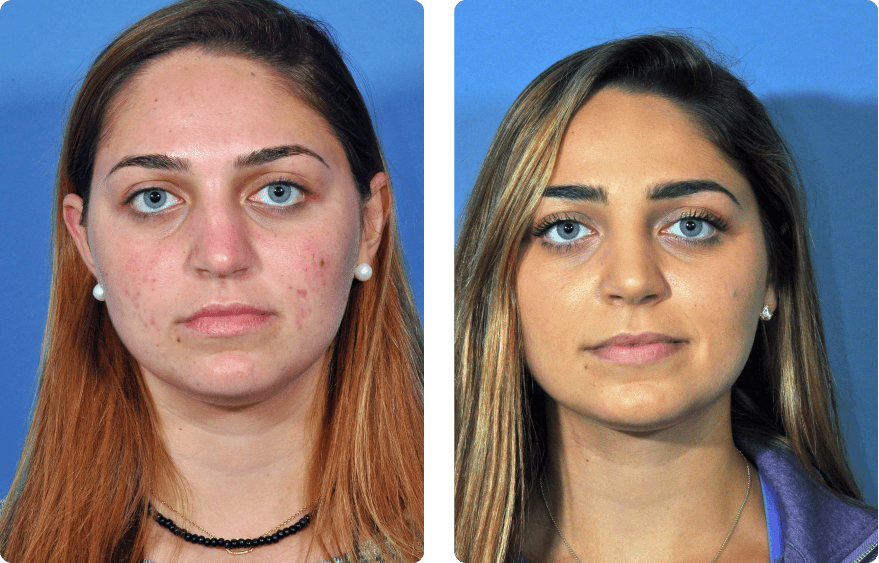 Woman’s face before and after - Rhinoplasty & Revision Rhinoplasty treatment, front view, patient 7