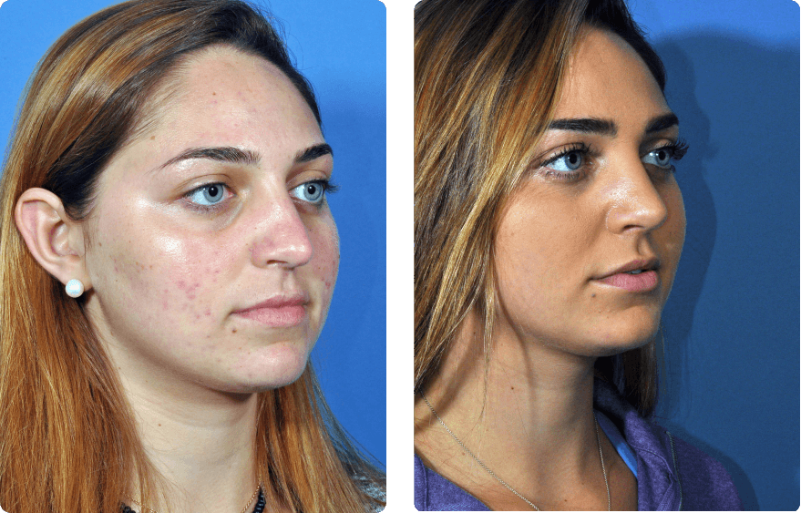 Woman’s face before and after - Rhinoplasty & Revision Rhinoplasty treatment, r-side oblique view, patient 7