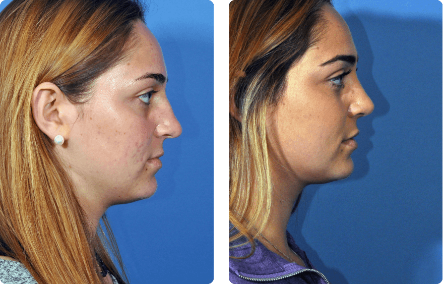 Woman’s face before and after - Rhinoplasty & Revision Rhinoplasty treatment, r-side view, patient 7
