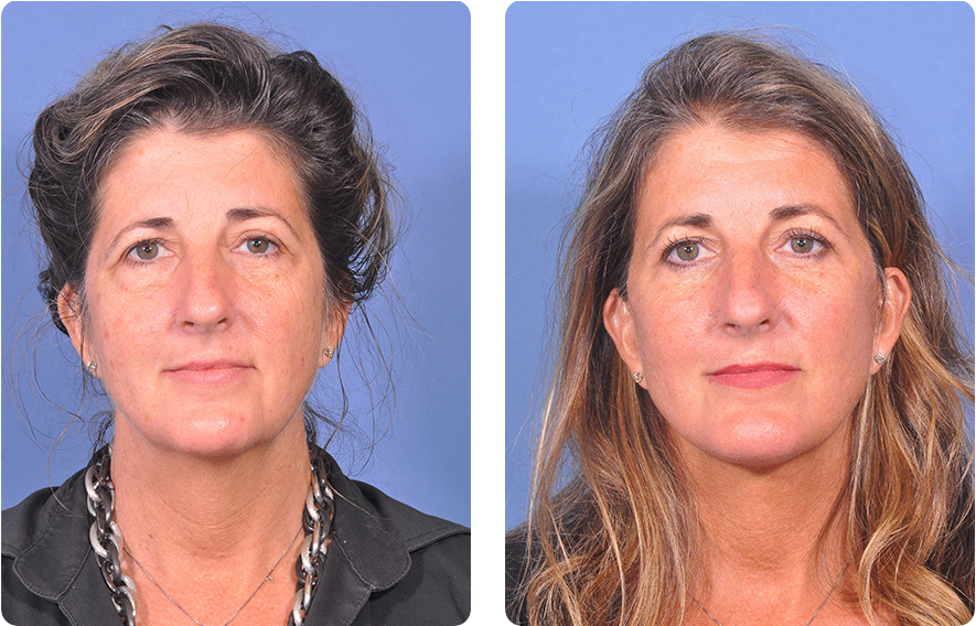 Woman’s face before and after - Upper Lid Blepharoplasty And Brow Lift treatment, front view, patient 11