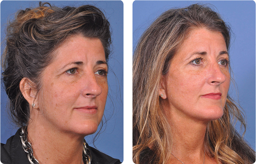 Woman’s face before and after - Upper Lid Blepharoplasty And Brow Lift treatment, oblique view, patient 11