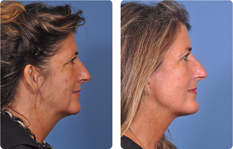 Woman’s face before and after - Upper Lid Blepharoplasty And Brow Lift treatment, r-side view, patient 11