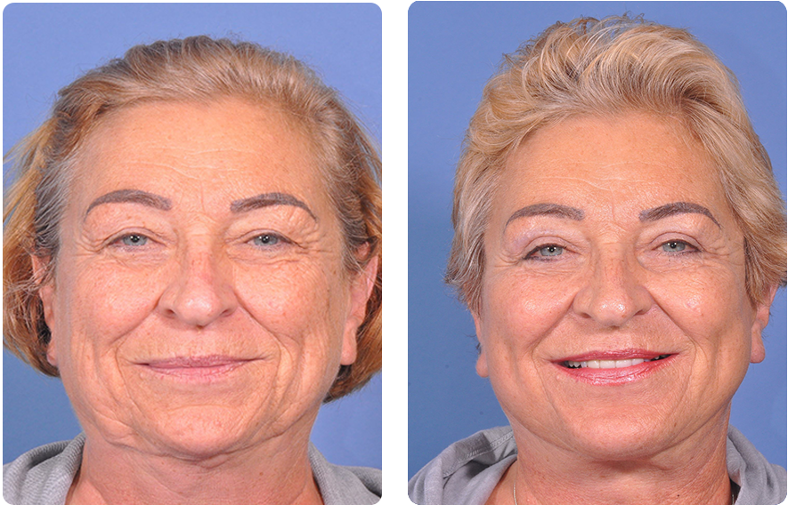 Woman’s face before and after - Upper Lid Blepharoplasty And Brow Lift treatment, front view, patient 12
