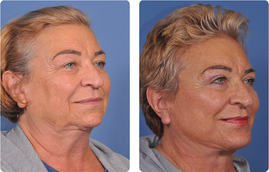 Woman’s face before and after - Upper Lid Blepharoplasty And Brow Lift treatment, oblique view, patient 12