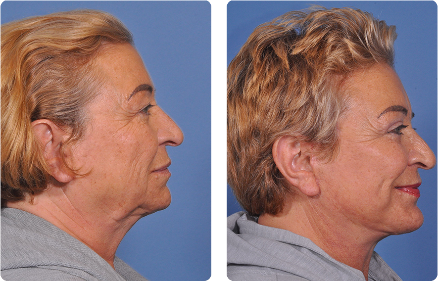 Woman’s face before and after - Upper Lid Blepharoplasty And Brow Lift treatment, r-side view, patient 12