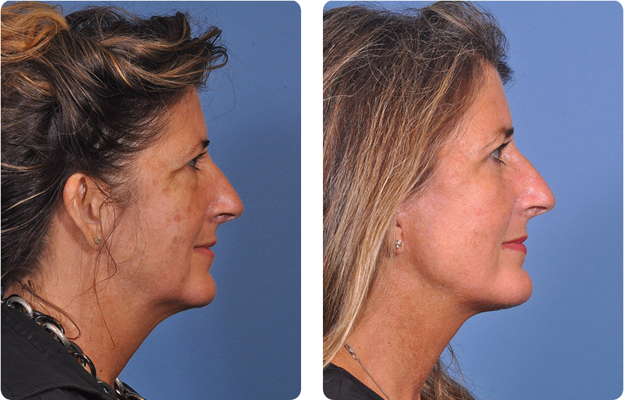 Woman’s face before and after - Chin Implant treatment, r-side view, patient 2