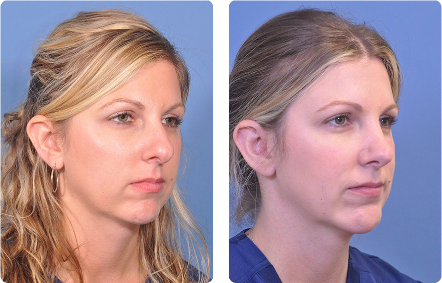Woman’s face before and after - Chin Implant treatment, oblique view, patient 3