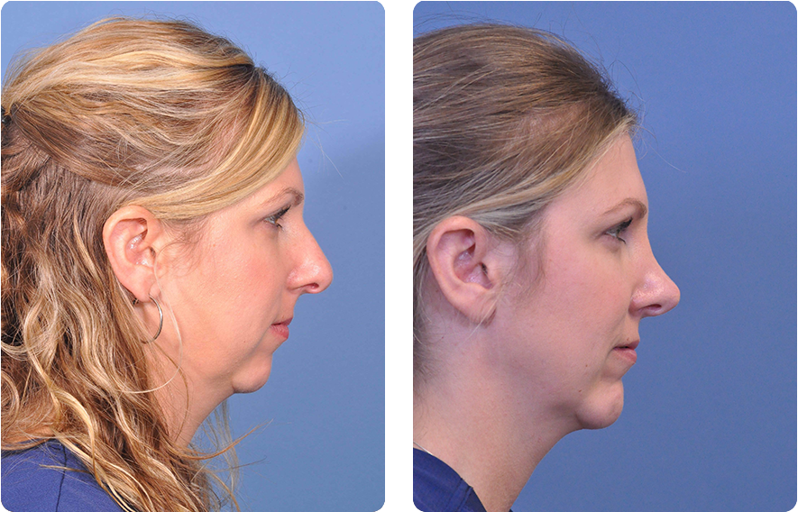 Woman’s face before and after - Chin Implant treatment, r-side view, patient 3
