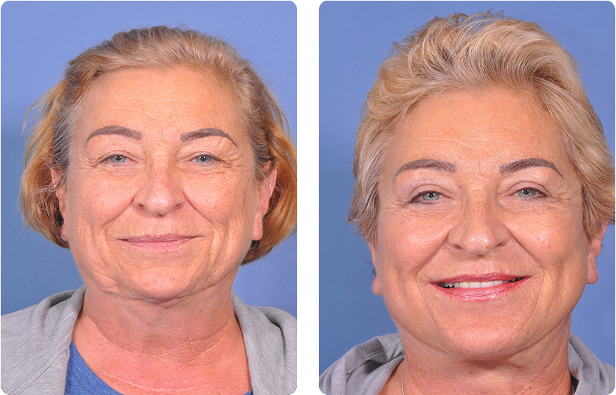 Woman’s face before and after - Chin augmentation treatment, front view, patient 4