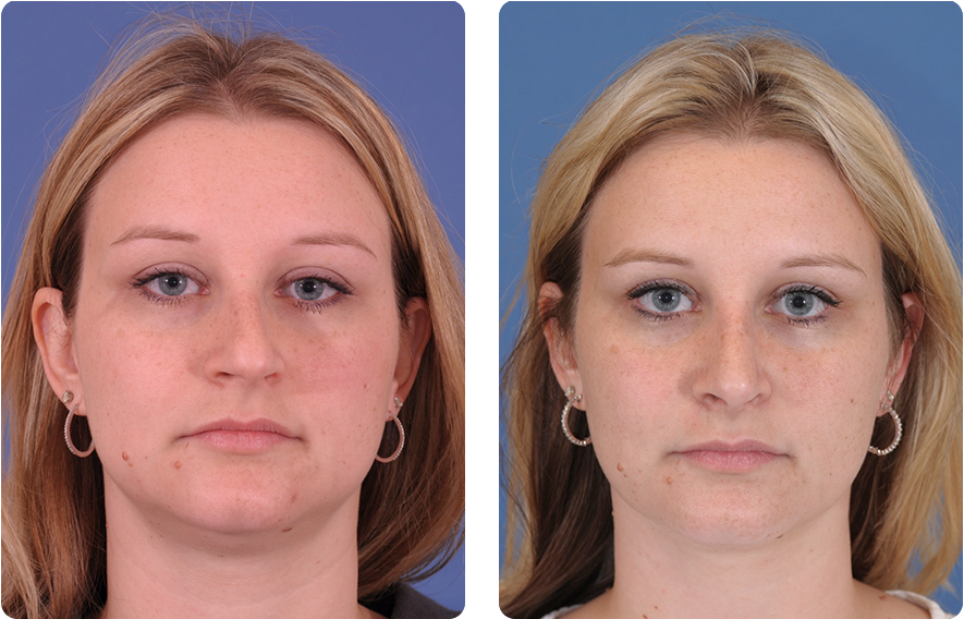 Woman’s face before and after - Rhinoplasty treatment, front view, patient 7