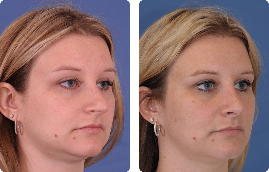 Woman’s face before and after - Rhinoplasty treatment, oblique view, patient 7