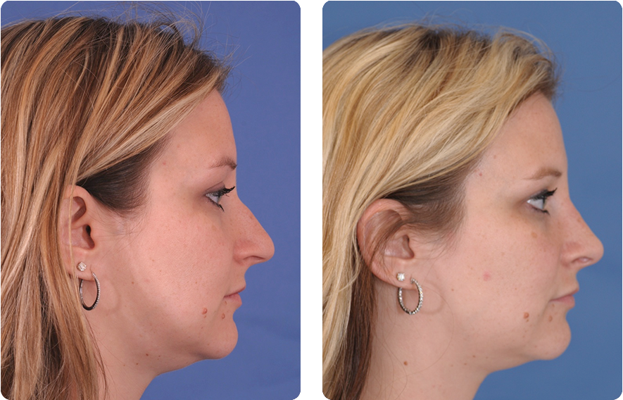 Woman’s face before and after - Rhinoplasty treatment, r-side view, patient 7