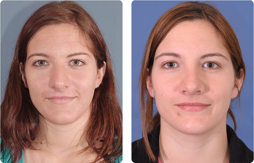 Woman’s face before and after - Rhinoplasty treatment, front view, patient 8