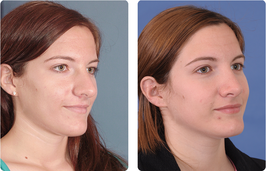 Woman’s face before and after - Rhinoplasty treatment, oblique view, patient 8