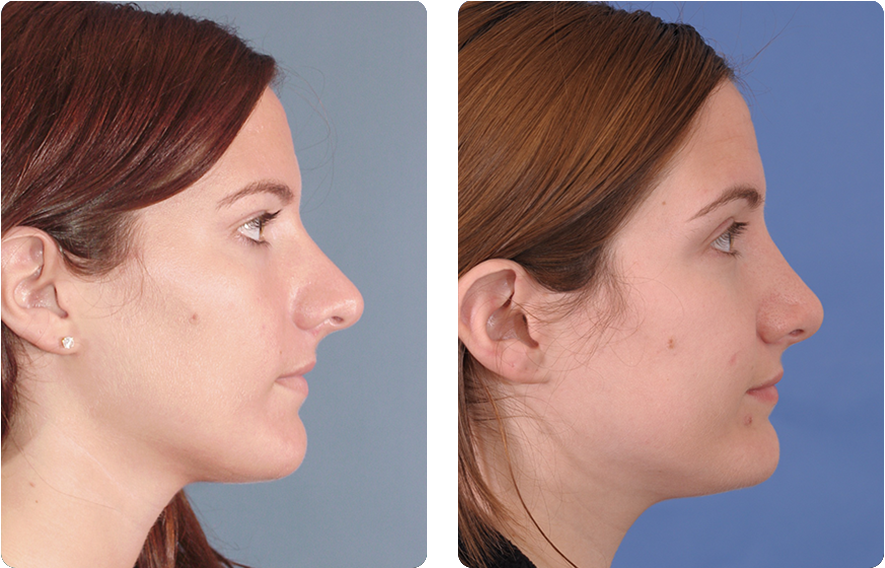 Woman’s face before and after - Rhinoplasty treatment, r-side view, patient 8