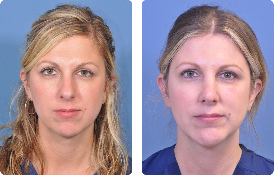 Woman’s face before and after - Rhinoplasty treatment, front view, patient 9