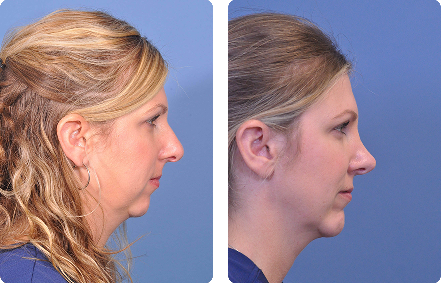 Woman’s face before and after - Rhinoplasty treatment, r-side view, patient 9