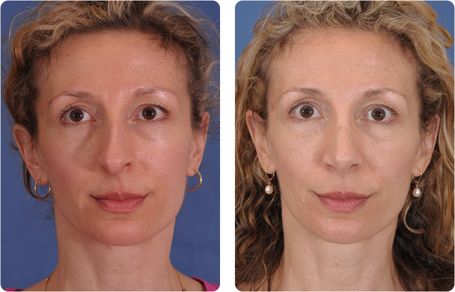 Woman’s face before and after - Rhinoplasty treatment, front view, patient 6