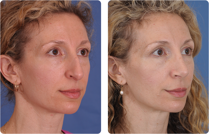 Woman’s face before and after - Rhinoplasty treatment, oblique view, patient 6
