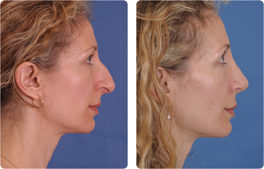 Woman’s face before and after - Rhinoplasty treatment, r-side view, patient 6