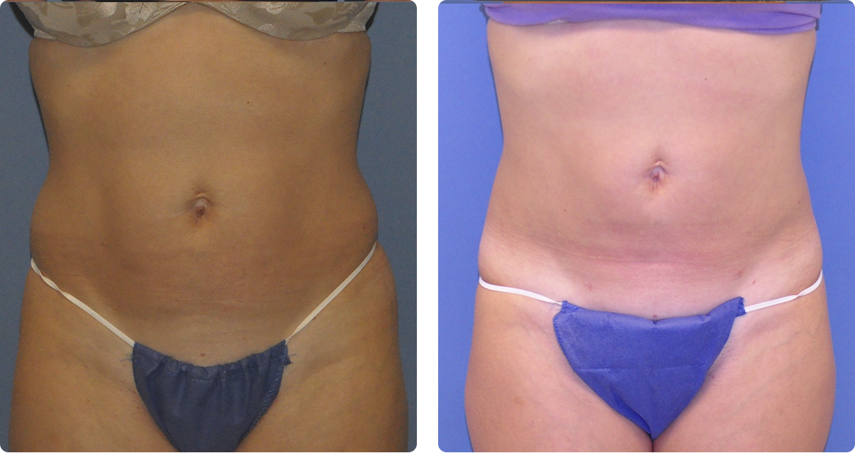 Photo of the patient’s body before and after the Body Contouring treatment. Set 1. Patient 4