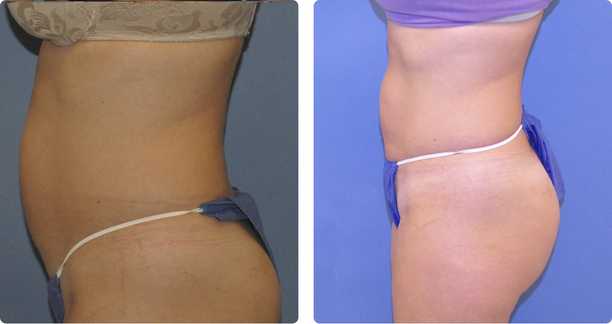 Photo of the patient’s body before and after the Body Contouring treatment. Set 2. Patient 4