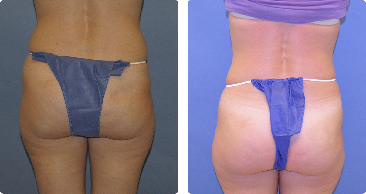 Photo of the patient’s body before and after the Body Contouring treatment. Set 3. Patient 4