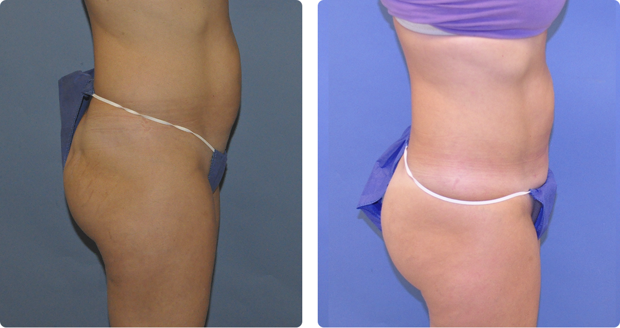 Photo of the patient’s body before and after the Body Contouring treatment. Set 4. Patient 4