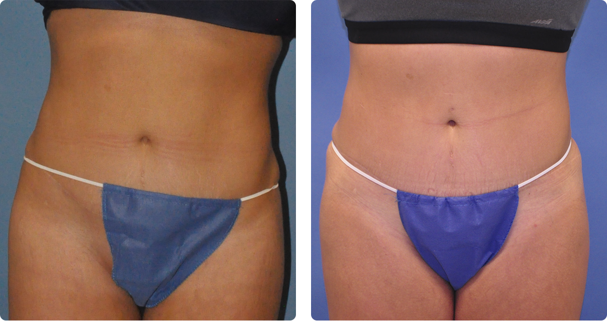 Photo of the patient’s body before and after the Body Contouring treatment. Set 1. Patient 3