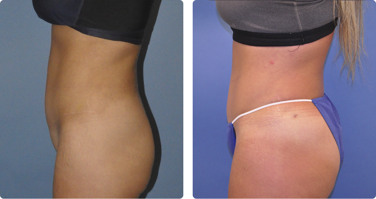 Photo of the patient’s body before and after the Body Contouring treatment. Set 2. Patient 3