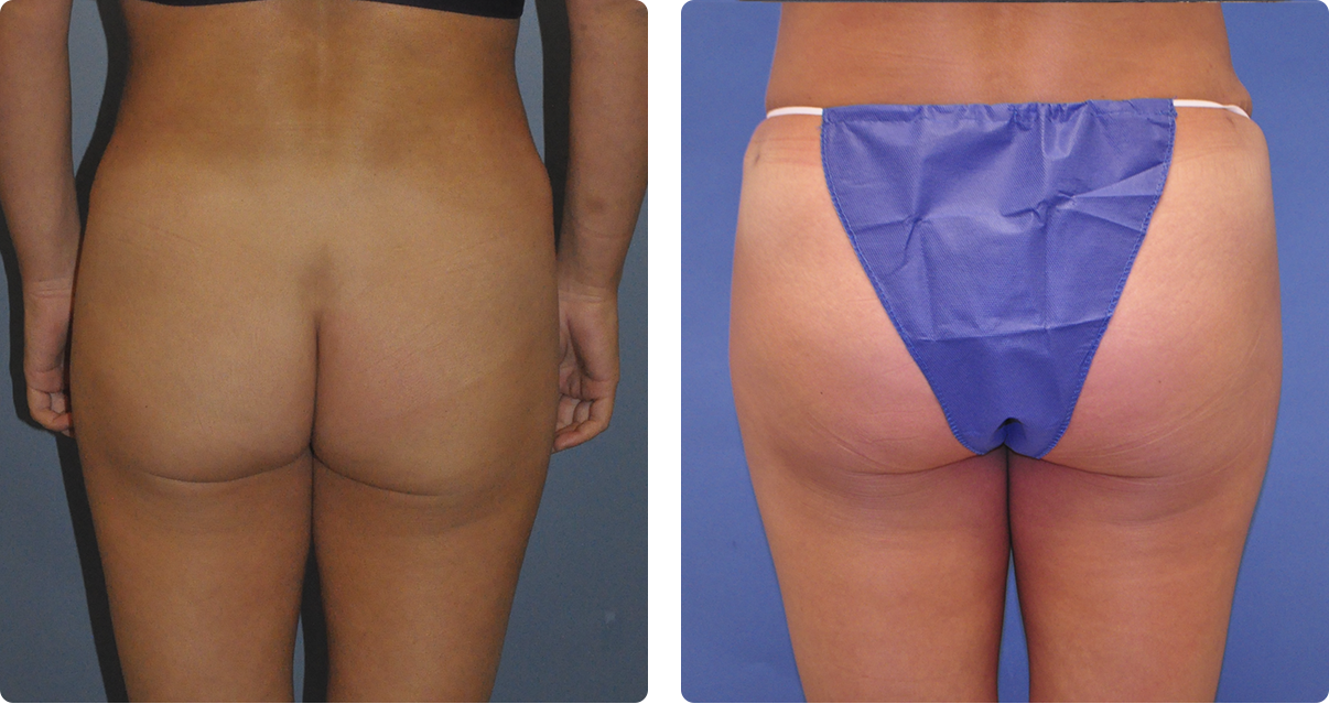 Photo of the patient’s body before and after the Body Contouring treatment. Set 3. Patient 3