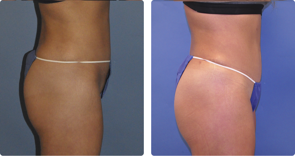Photo of the patient’s body before and after the Body Contouring treatment. Set 4. Patient 3