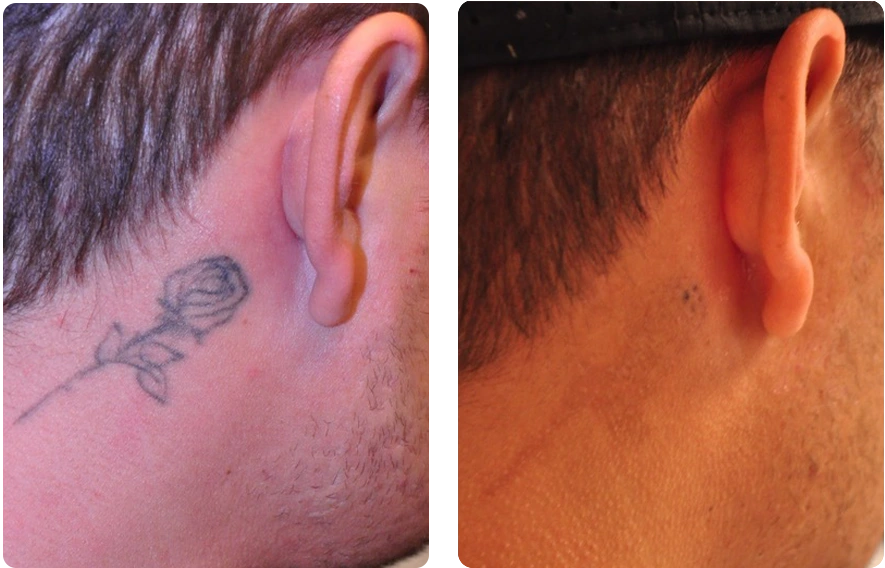 View Before and After Results